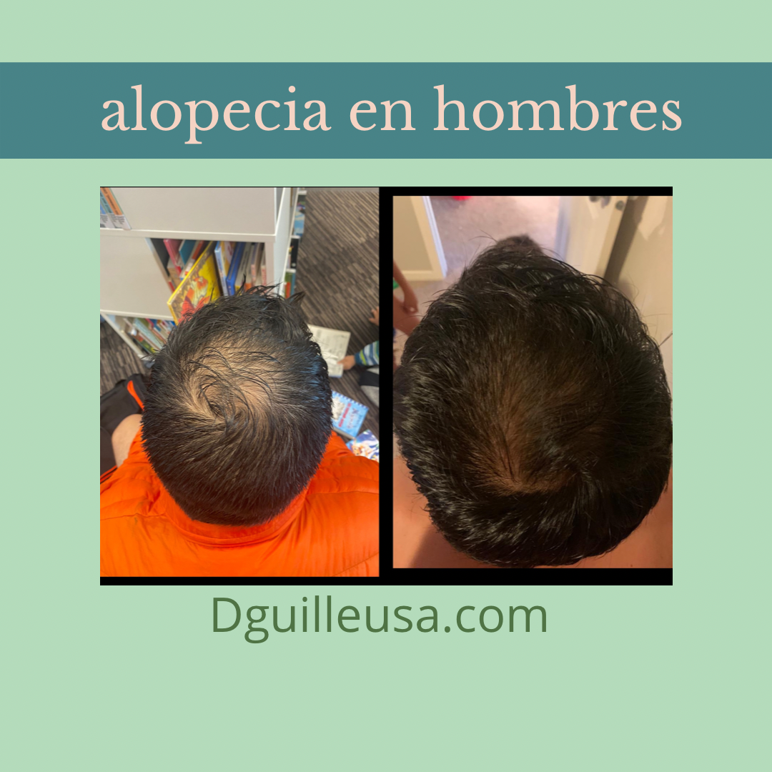 alopecia en hombres